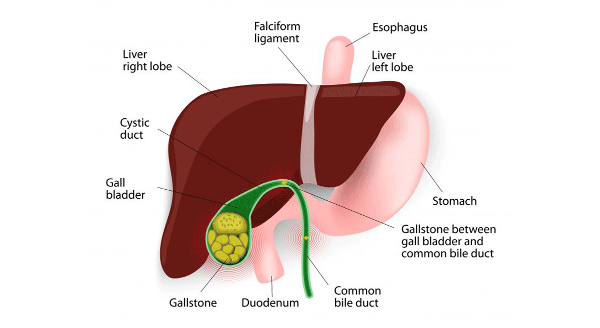 Gallbladder stones గాల్ బ్లాడర్ స్టోన్స్