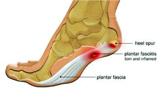 Heel Pain మడిమ నొప్పి