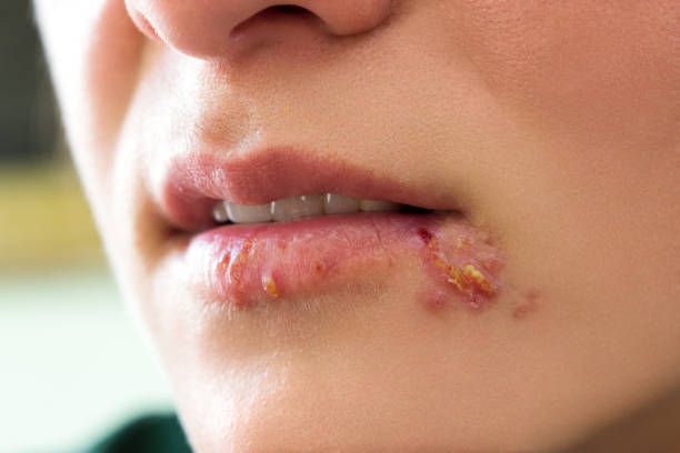 Herpes హెర్పిస్ సుఖ వ్యాధి