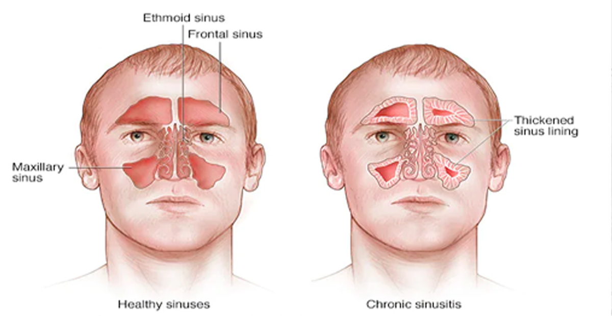 Sinusitis Treatment శాశ్వత పరిష్కారం