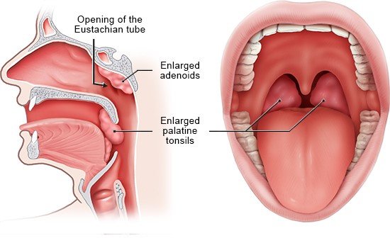 Adenoids