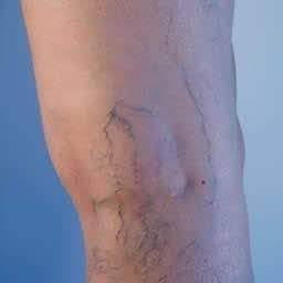 Varicose veins వెరికోస్‌ వెయిన్స్‌