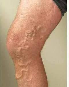 Varicose veins వెరికోస్‌ వెయిన్స్‌