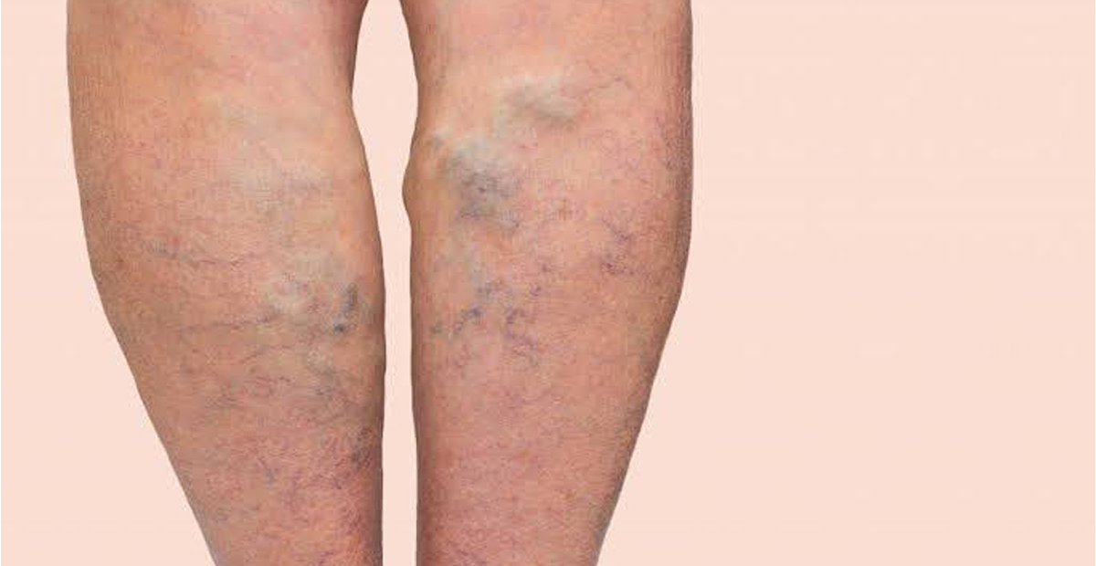 Varicose veins వెరికోస్‌ వెయిన్స్‌