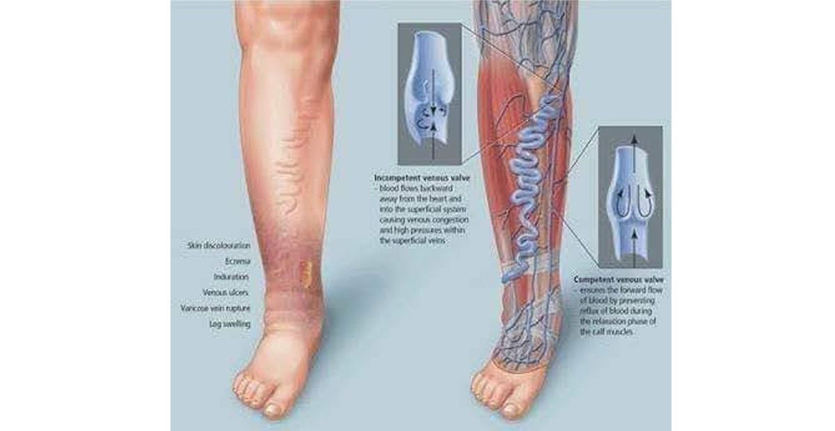 Varicose veins వెరికోస్‌ వెయిన్స్‌