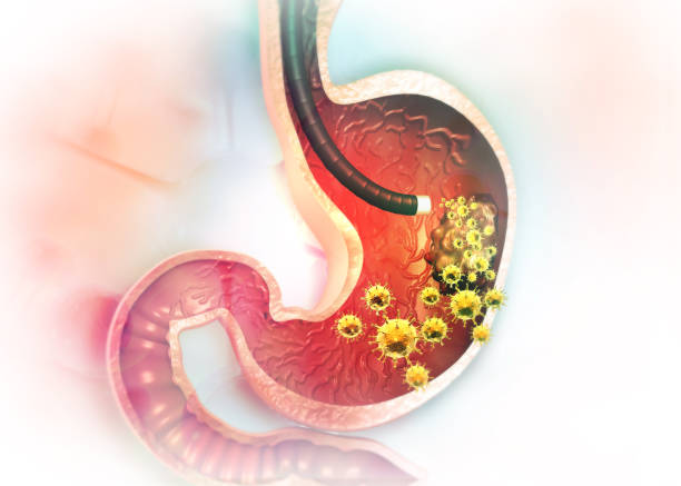 colon ulcers ప్రేగుపూత మంట