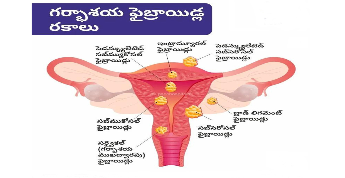 గర్భాశయ ఫైబ్రాయిడ్లకు చికిత్సUterine fibroids treatment