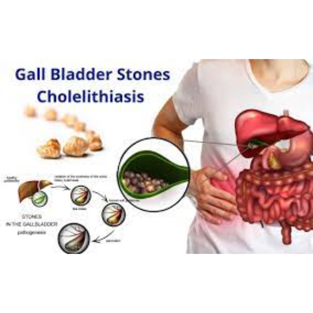 gallbladder-stone-treatment