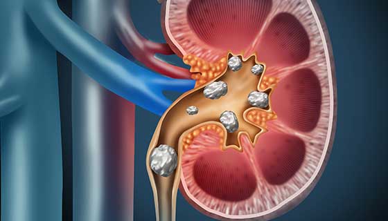 kidney stones ఆయుర్వేద చికిత్స