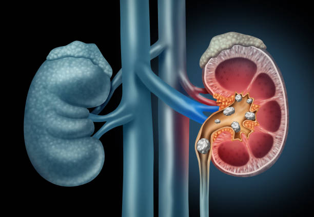 kidney stones ఆయుర్వేద చికిత్స