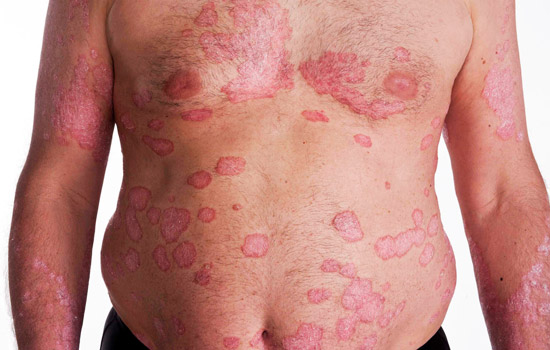 Psoriasis Permanent Treatment సొరియాసిస్‌కు శాశ్వత పరిష్కారం