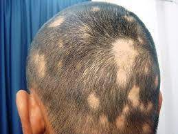 Alopecia పేను కొరుకుడు