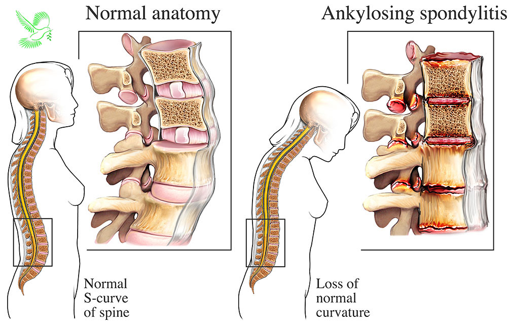 Spondylitis Treatment వెన్నునొప్పి ఆయుర్వేదం