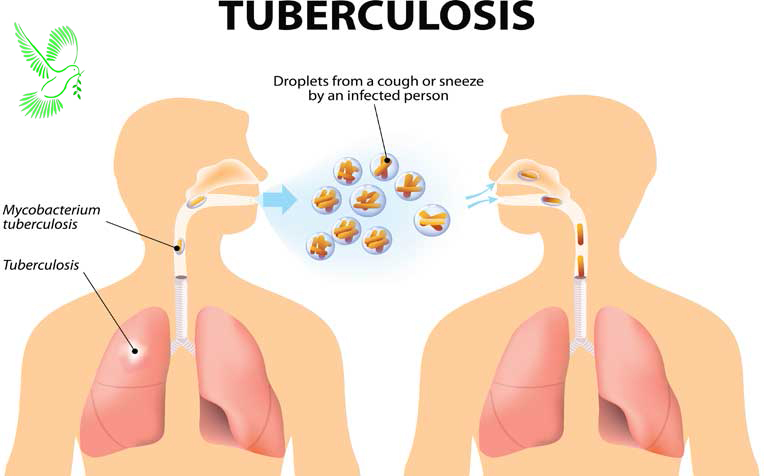 Tuberculosis (TB) క్షయ వ్యాధి